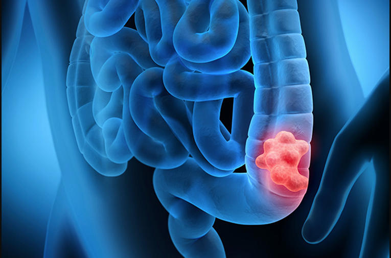 Colorectal Cancer