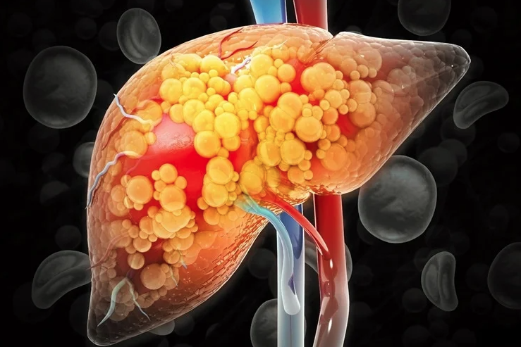 Semaglutide Shows Major Promise for Treating Serious Liver Disease in 2025
