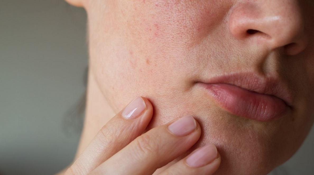 Dry skin vs dehydrated skin